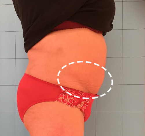 After treatment