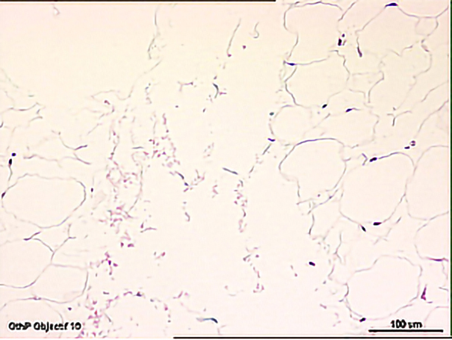 Human explant after treatment